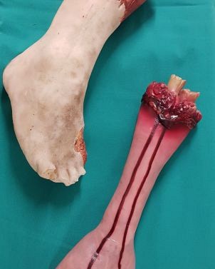 Severed Limbs