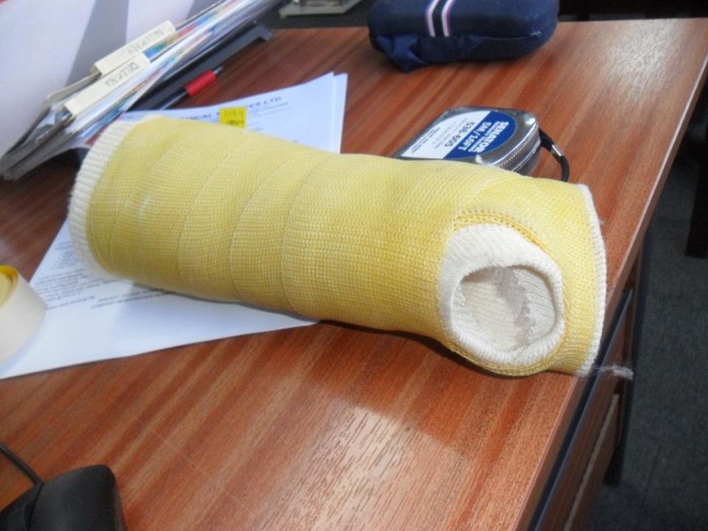 Plaster arm cast