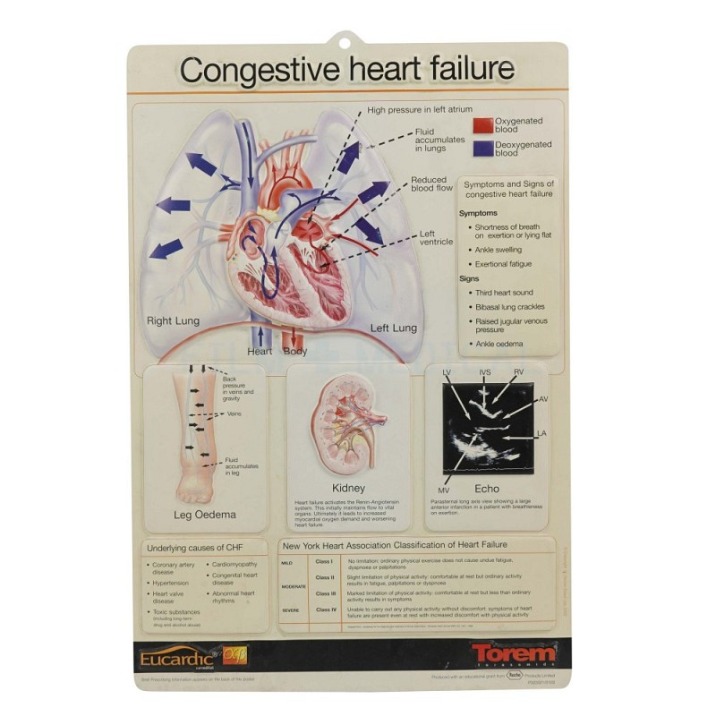 Congestive Heart Failure Poster 3D