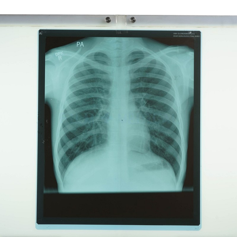 X-Ray Chest