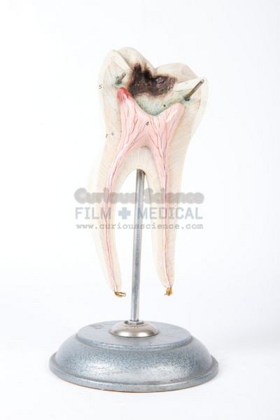 Model of decayed tooth