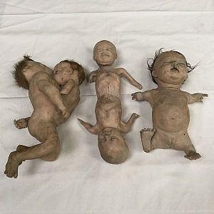 Conjoined babies and thalidomide baby